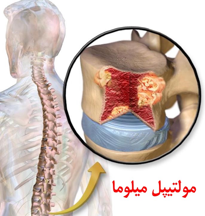 سرطان های مولتیپل میلوما