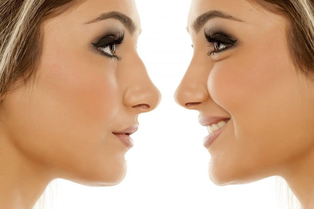 جراحی بینی برای چه کسانی مناسب است؟