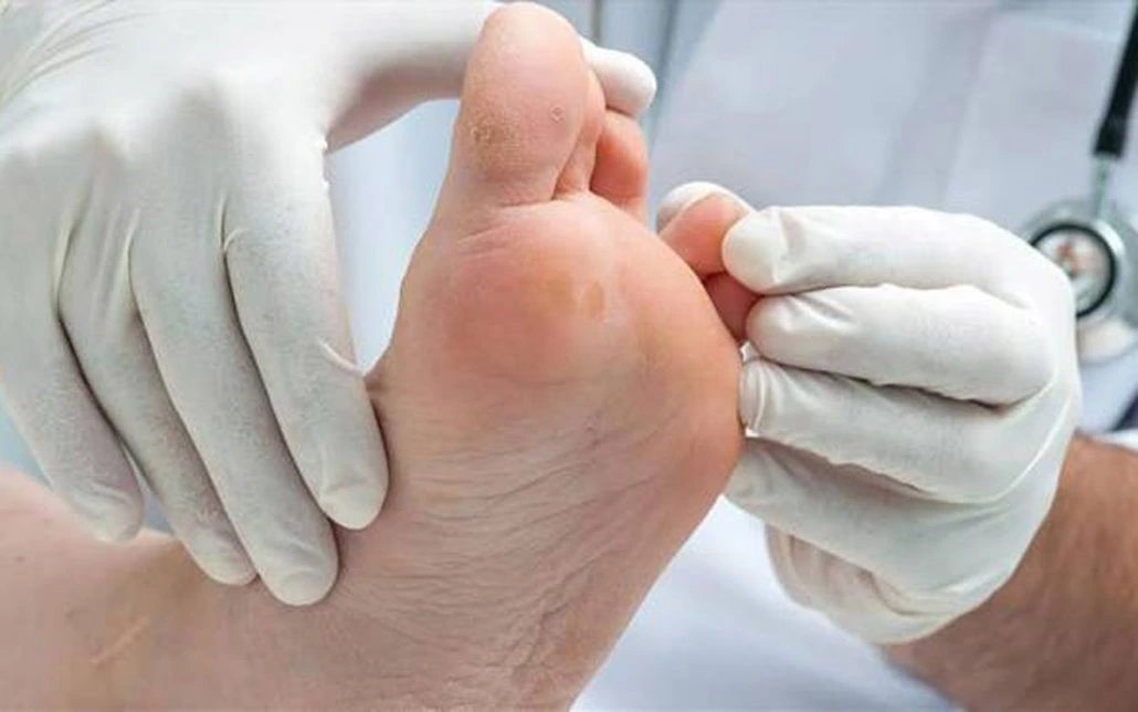مشکلات پای دیابتی؛ شایع اما قابل پیشگیری