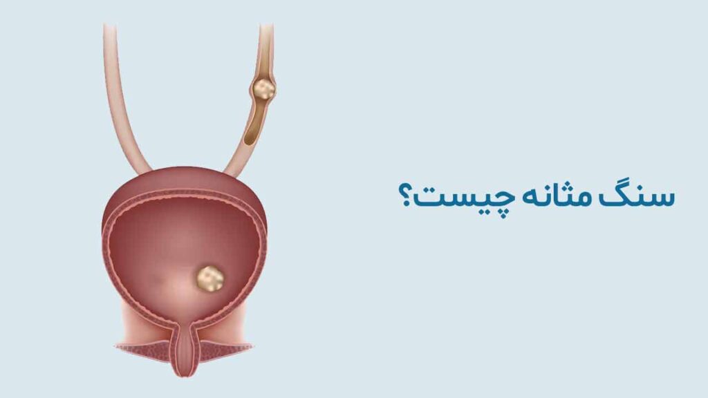 جراحی های رباتیک در درمان سنگ های مثانه