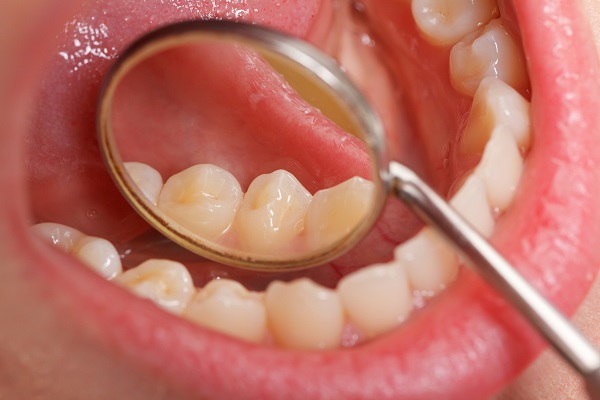 علائم اولیه سرطان دهان چیست ؟