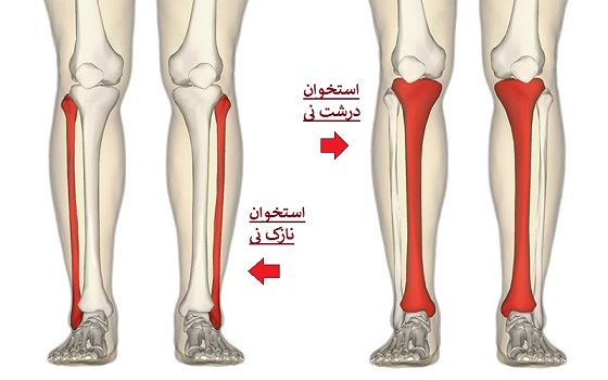 جراحی های رباتیک در ترمیم شکستگی های استخوانی