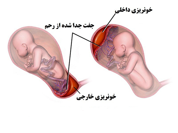 اختلالات تیروئید در بارداری چه خطراتی دارد