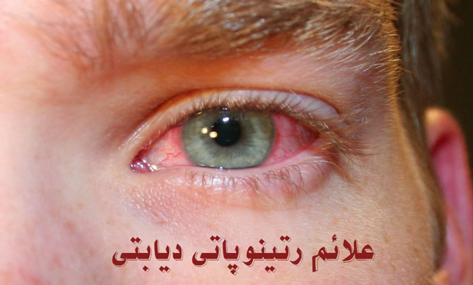 رتینوپاتی دیابتی: تأثیر دیابت بر چشم ها