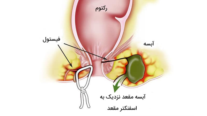 چه مشکلاتی در روابط مقعدی به وجود می آید