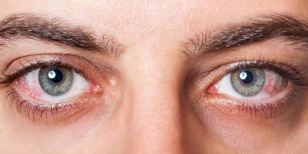 آب مروارید مرتبط به دیابت : چگونه پیشگیری کنیم ؟