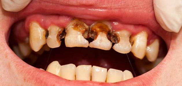 آیا خرابی دندان میتواند نشانه بیماری باشد