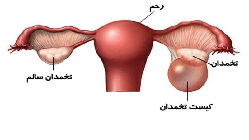 جراحی های رباتیک در برداشتن کیست های تخمدان چه تأثیری دارد ؟