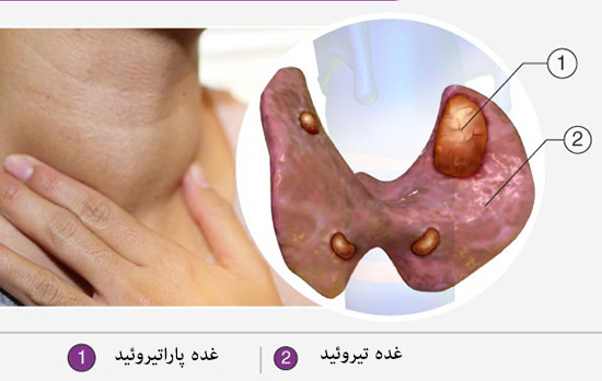 پاراتیروئید چیست و چه درمانی دارد؟