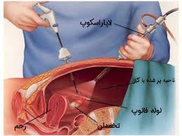 جراحی های رباتیک در برداشتن تومور های تخمدان
