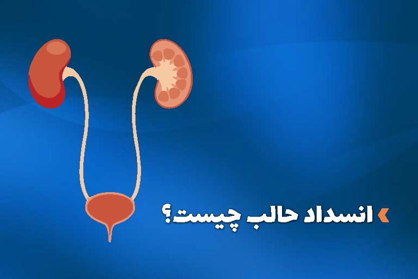 علائم انسداد حالب چیست ؟